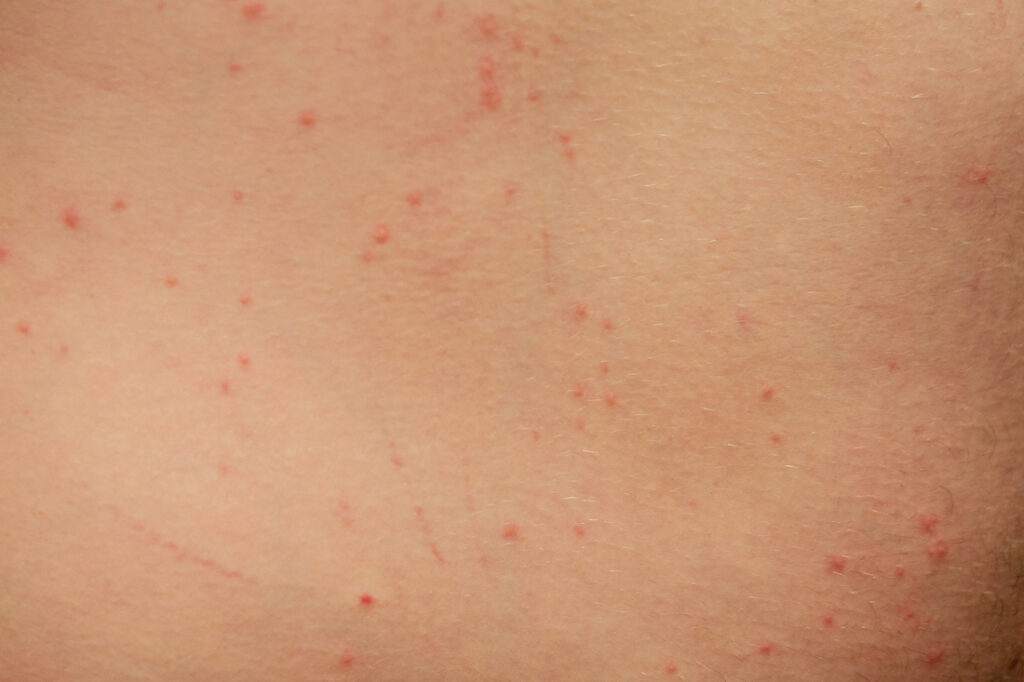 Dermatitis por Picaduras: Reacciones Cutáneas