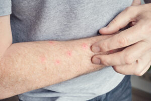 Enfermedades que Transmiten los Ácaros Síntomas y Tratamientos